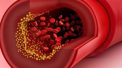 أعراض ارتفاع الكوليسترول .. وطرق السيطرة عليه