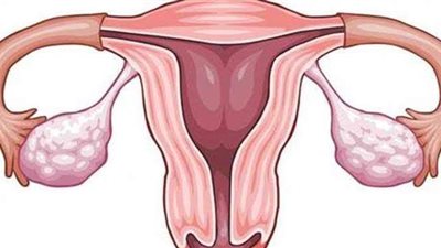 أسباب سقوط الرحم وكيفية علاجه