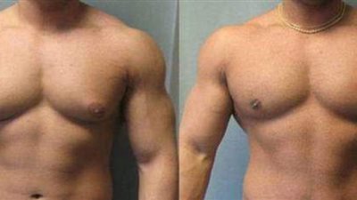 التثدي عند الرجال.. استشاري يوضح خطوات التخلص من المشكلة