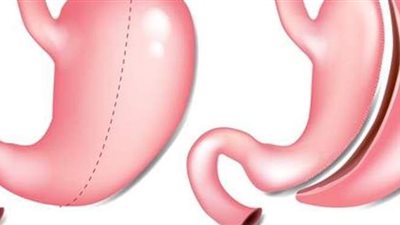 ما هي فوائد عملية ربط المعدة؟ وما هي نتائجها؟