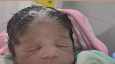 مفاجأة طبية في ولادة طفلة الشعر الأبيض بالأقصر | فيديو