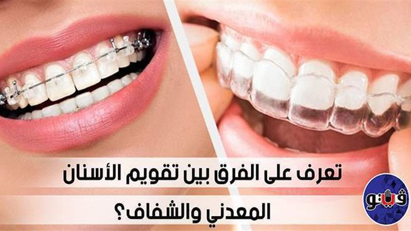الفرق بين تقويم الأسنان