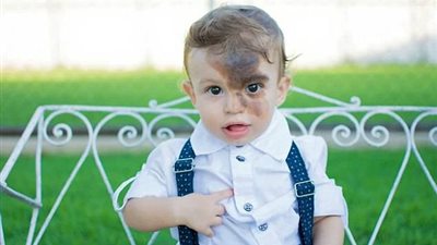 أم ترسم «وحمة» على وجهها لعلاج ابنها نفسيا (صور)