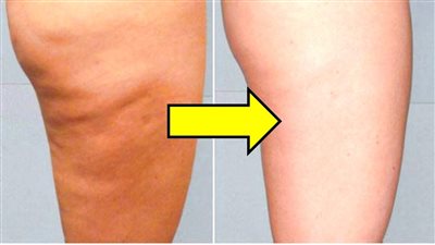 دراسة: تراكم الدهون في الأرداف مؤشر عن نقص فيتامين د