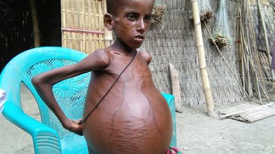 انتفاخ بطن طفل هندي يصل إلى حجم كرتي قدم