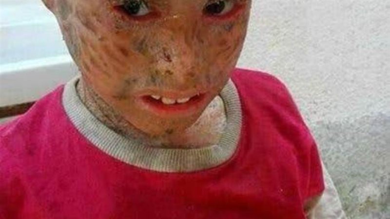 مرض قشرة السمك
