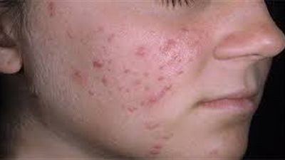 5 خطوات طبيعية لعلاج حبوب البشرة
