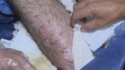 بالصورة.. داعش تشن هجوما كيميائيا على البيشمركة بالعراق