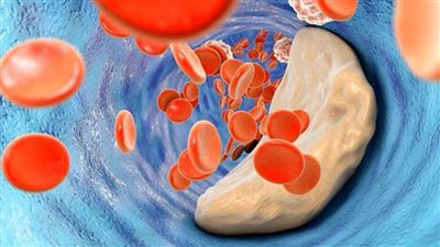 5 مواد طبيعية لخفض الكوليسترول في الدم