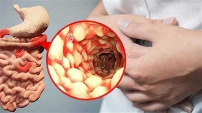 11 معلومة عن مرض كرون.. يزيد من خطر الإصابة بالسرطان