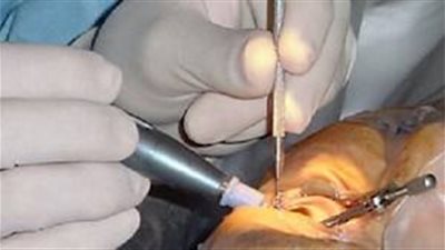 طالب يفقأ عين زميله بمدرسة بالقليوبية