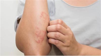 علاج الاكزيما بالأعشاب | 13 وصفة طبيعية تساعدك على التخلص من الألم