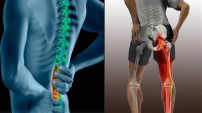 5 نصائح تساعد فى علاج عرق النسا