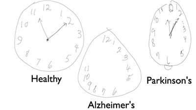 «الأقلام الرقمية» تكشف عن أمراض المخ