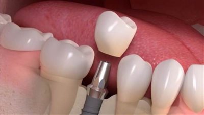 كل ما تريد معرفته عن عملية زراعة الأسنان