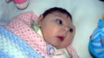 طفرة جينية السبب وراء تشوهات المخ لدى الأطفال