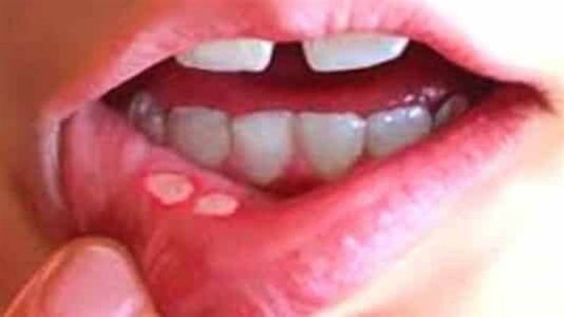 مرض بهجت