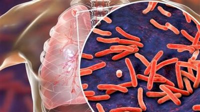 السل | 10 معلومات عن المرض أبرزها توفير العلاج بالمجان في مستشفيات الصدر