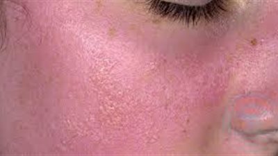 قناع القهوة واللبن يخفف من حروق الشمس على البشرة في الصيف