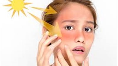 استشاري: حروق الشمس سبب مباشر للإصابة بسرطان الجلد