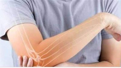 علاج مرض العظم الزجاجي وأبرز المشاهير المصابين به