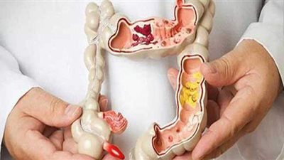 علاج 1222 حالة مصابة بسرطان القولون خلال عام
