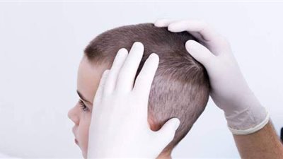 4 طرق طبيعية لعلاج القمل في المنزل