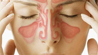 تعرف على أعراض حساسية الجيوب الأنفية.. وعلاجها بالأعشاب