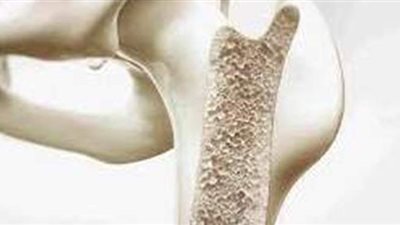 أعراض هشاشة العظام .. وأسباب الإصابة والعلاج