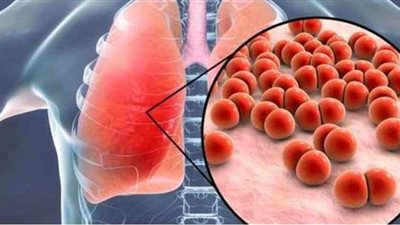 اليوم العالمي للسل.. كل ما تريد معرفته عن المرض وأسبابه