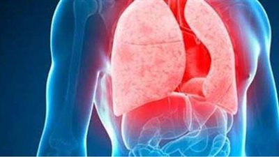 ٥ أعراض لمرض الدرن