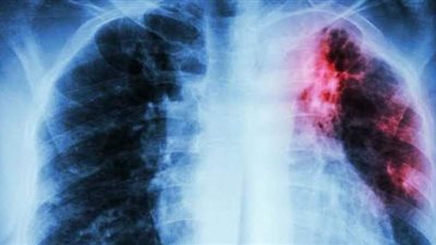 ما هو السل المقاوم للأدوية وطرق علاجه؟