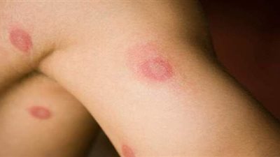 طرق التخلص من الفطريات بشكل نهائي