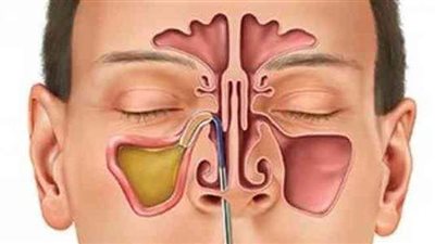 نصائح لمرضي الجيوب الأنفية خلال هذا الطقس