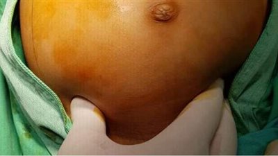 استئصال ورم خلقي من بطن طفل في الإسكندرية