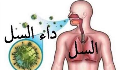 أعراض مرض السل.. 