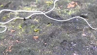 أطباء في تايلاند يستخرجون دودة طولها 18 متراً من أمعاء رجل | فيديو