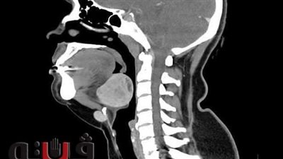 استئصال غدة درقية نادرة بالجزء الخلفي من اللسان لشابة بـ 