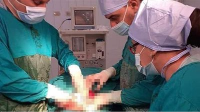 فريق طبي بمستشفى تلا ينجح في استئصال ورم يزن 30 كيلو من فتاة