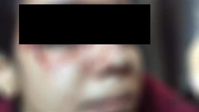 والد فتاة الساطور بمطروح ينفي بتر يدها: مازالت في العمليات