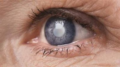 أعراض المياه البيضاء