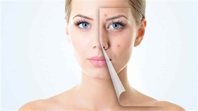 وصفة لحبوب الوجه بـ2 جنيه فقط والنتيجة مذهلة