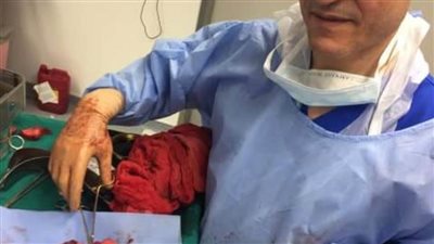 فريق طبي بمستشفى كفر الشيخ الجامعي ينجح في استئصال ورم نادر يزن 1680 جراما