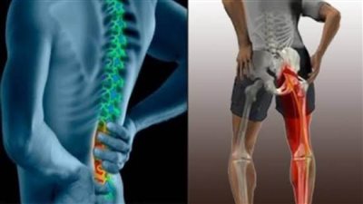 نصائح وأعشاب لعلاج عرق النسا بدون آلام