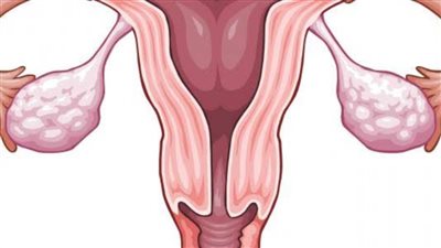 تكيس المبايض | 9 أعراض تظهر على المرأة عند الإصابة بتكيس المبايض
