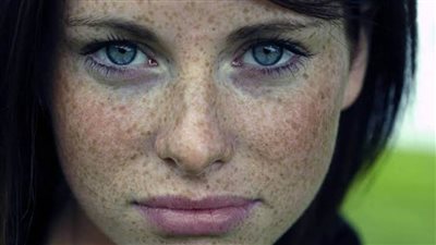 ٥ وصفات طبيعية لعلاج النمش على البشرة