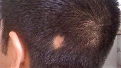 وصفة طبيعية تساعد في علاج الثعلبة