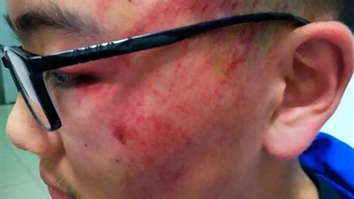 معلم يتسبب في فقدان سمع طفل بعد صفعه 12 مرة على وجهه (فيديو وصور)