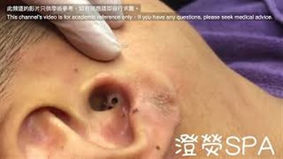 عملية غريبة لتنظيف أذن شاب بها 4 ثقوب (فيديو)