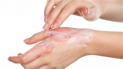 وصفات من مطبخك لعلاج الحروق السريع ودون ترك أثر